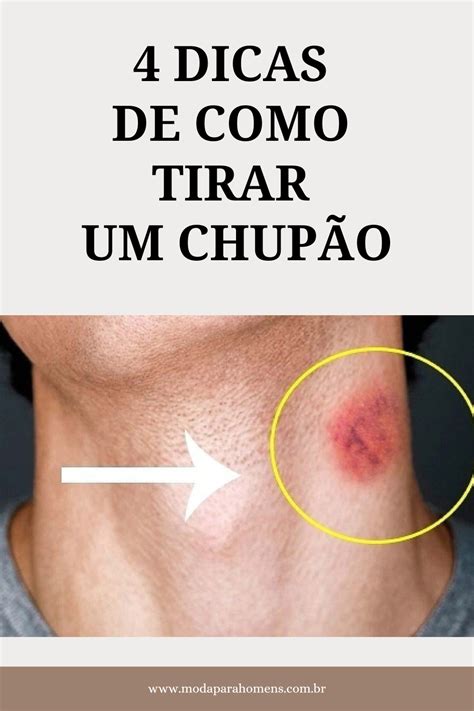 como tirar um chupao|4 Dicas de Como Tirar um Chupão